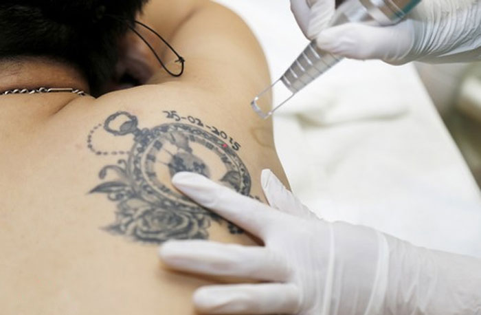 Who should have YAG Laser tattoo removal?