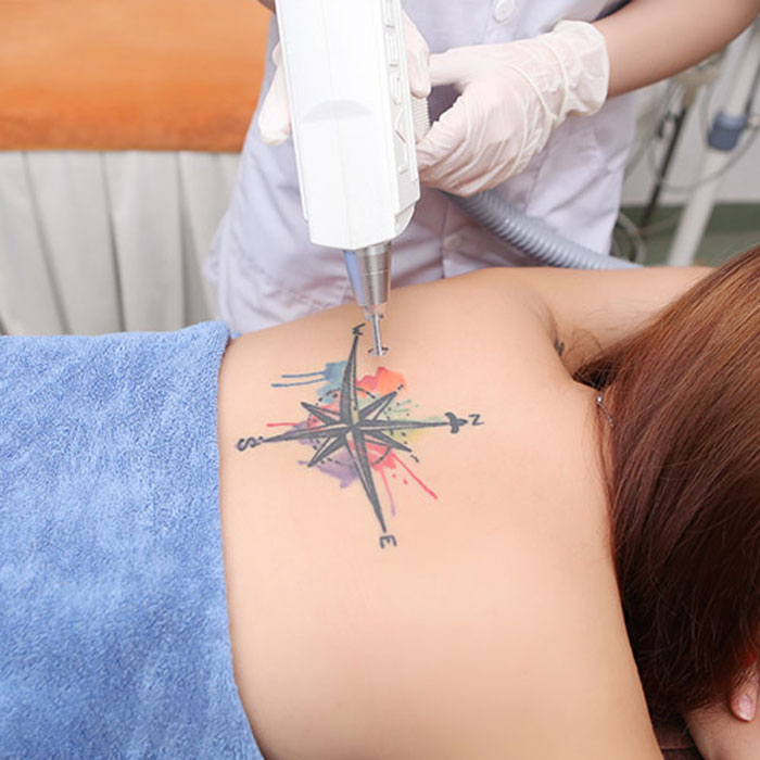How does YAG Laser tattoo removal work?