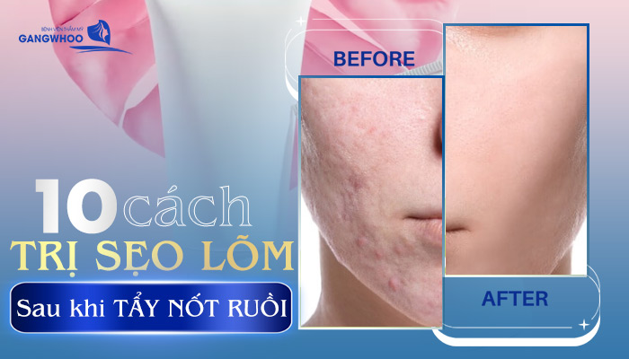 10 Cách Trị Sẹo Lõm Sau Khi Tẩy Nốt Ruồi Hiệu Quả 10 Cách Trị Sẹo Lõm Sau Khi Tẩy Nốt Ruồi