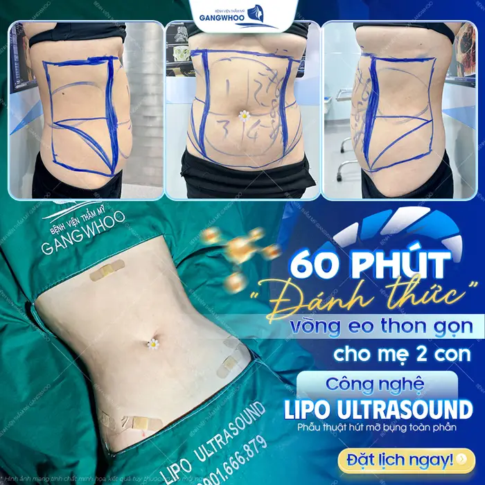 60 phút đánh thức vòng eo thon gọn ứng dụng công nghệ Lipo Ultrasound hiện đại an toàn và hiệu quả đẹp rõ