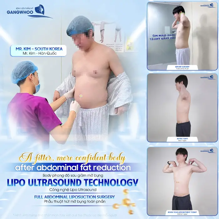 Body phong độ sau giảm mỡ bụng ứng dụng công nghệ Lipo Ultrasound 