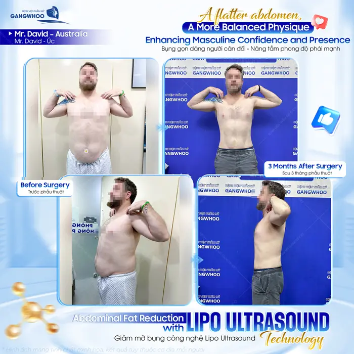Bụng gọn dáng người cân đối nâng tầm phong độ cho phái mạnh sau giảm mỡ công nghệ Lipo Ultrasound hiện đại