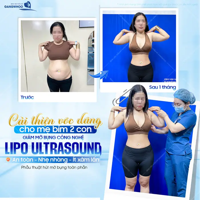 Cải thiện vóc dáng cho mẹ bỉm 2 con giảm mỡ bụng công nghệ Ultrasound thành công khoe eo con kiến đẹp nhỏ xinh