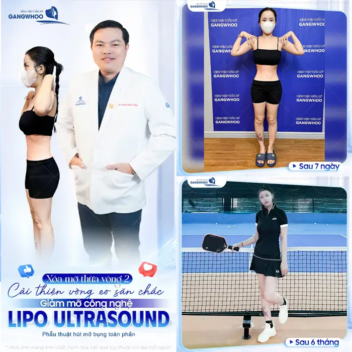 Xóa thừa mỡ vòng 2 cải thiện vòng eo săn chắc giảm mỡ công nghệ Lipo Ultrasound