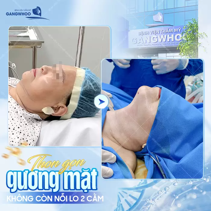 Hút Mỡ Nọng Cằm Giá Bao Nhiêu Tiền? (Cập Nhật Giá 2025) 7 Thon gọn gương mặt không lo cằm chảy xệ sau 1 lần thực hiện