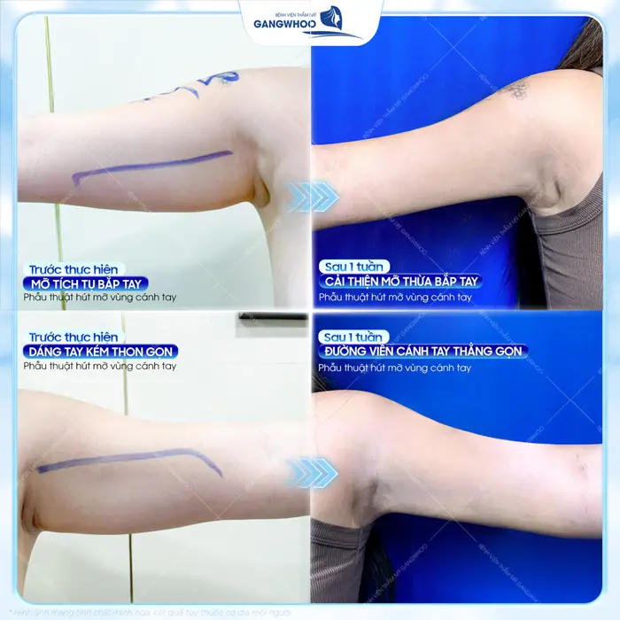 Kết quả sau 1 tuần phẫu thuật hút mỡ cánh tay tại bệnh viện thẩm mỹ Gangwhoo tự tin với đôi tay thon nuột sau phẫu thuật 