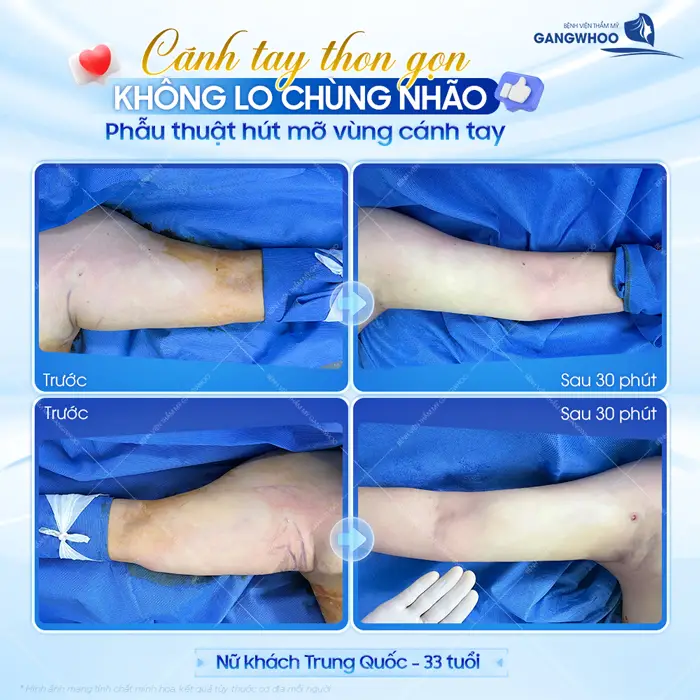 Cánh tay thon gọn không lo chùng nhão sau phẫu thuật hút mỡ vùng cánh tay đã hoàn toàn khác biệt 