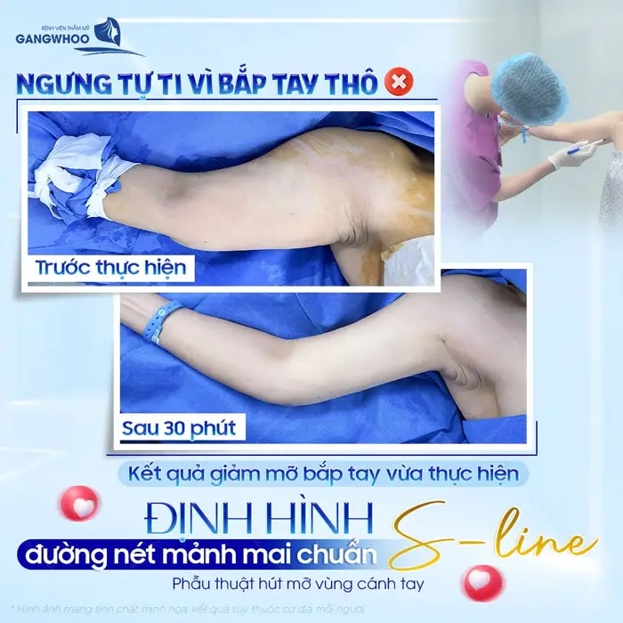 Kết quả sau giảm mỡ bắp tay vừa thực hiện xong đã thấy sự mảnh khảnh và hài hòa hơn sau 30 phút thực hiện