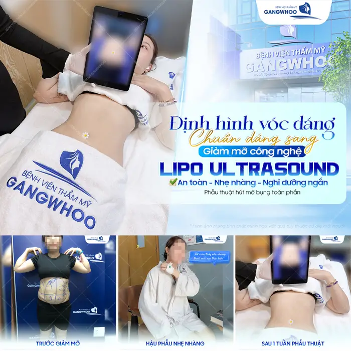 Định hình vóc dáng chuẩn dáng nuột đẹp sang sau phẫu thuật hút mỡ bụng toàn phần công nghệ Lipo Ultrasound hiện đại 