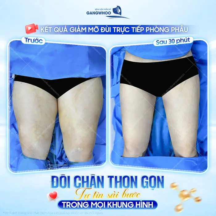 Kết quả giảm mỡ vùng đùi trực tiếp tại BVTM Gangwhoo chân đẹp thon gọn tự tin sải bước cân mọi khung hình