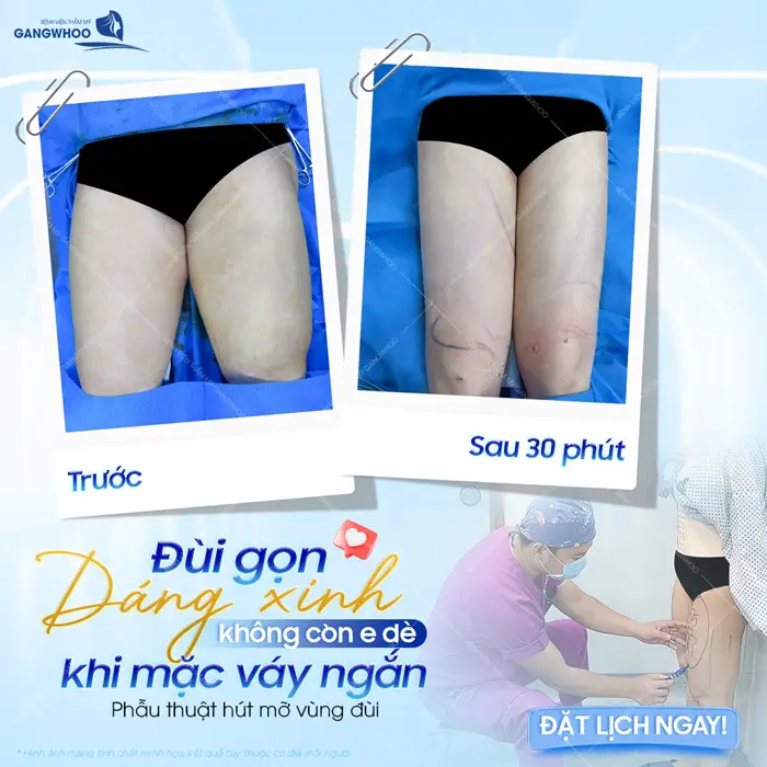 Đùi gọn dáng xinh không còn e dè khi mặc váy ngắn sau phẫu thuật hút mỡ vùng đùi ứng dụng công nghệ hiện đại 