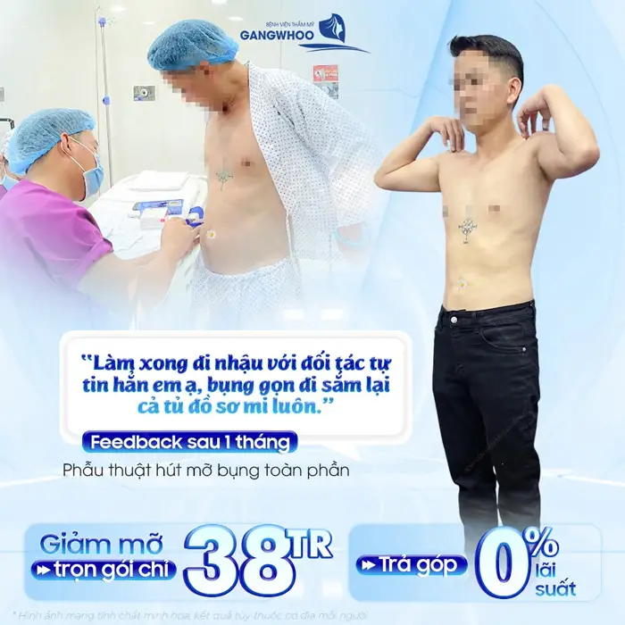 Giảm mỡ bụng toàn phần sau 1 tháng bụng gọn, phẳng phiu body đep hài hòa hơn thấy rõ