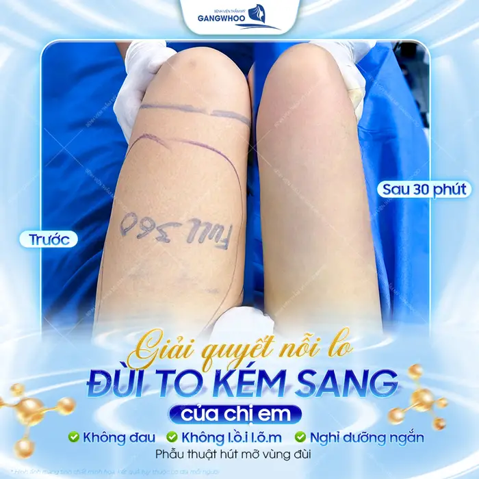 Giải quyết nỗi lo đùi to kém sang của chị em sau 30 phút thực hiện đã hoàn toàn khác biệt đến khó tin