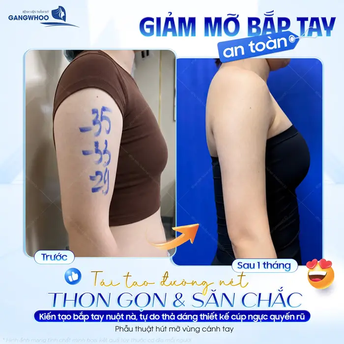 Giảm mỡ bắp tay an toàn tái tạo đường nét thon gọn và săn chắc kiến tạo dáng nuột chuẩn đẹp với tỷ lệ cơ thể