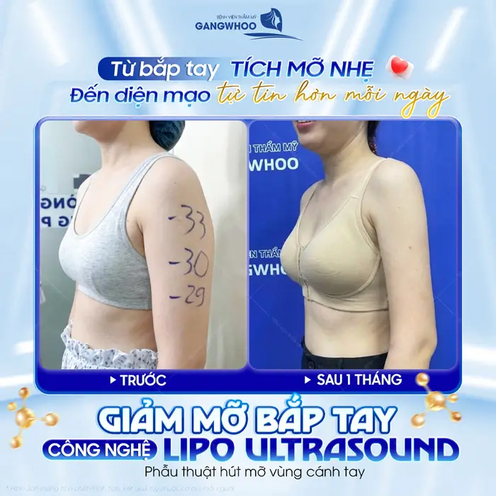 Hút Mỡ Bắp Tay Bao Nhiêu Tiền? Bảng Giá Mới Năm 2026 23 Từ bắp tay tích mỡ đến diện mạo tự tin hơn mỗi ngày kết quả sau giảm mỡ bắp tay công nghệ Lipo Ultrasound