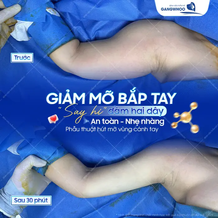 Giảm mỡ bắp tay tự tin diện đầm 2 dây an toàn, nhẹ nhàng sau 30 phút đã hoàn toàn khác biệt