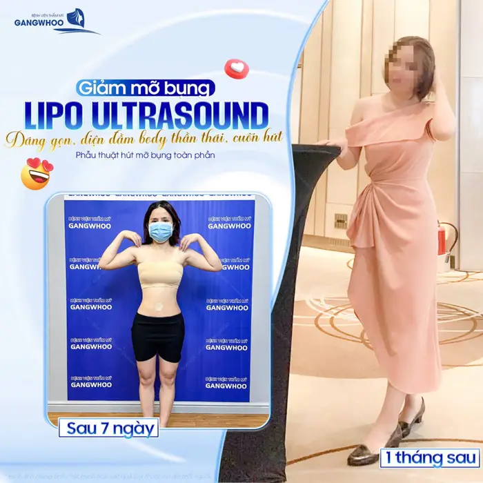 Có Nên Hút Mỡ Bụng Sau Sinh Em Bé Không? Bác Sĩ Giải Đáp 7 Giảm mỡ bụng Lipo Ultrasound dáng gọn, tự tin diện đầm đẹp chuẩn thần thái sắc vóc thăng hạng đầy cuốn hút