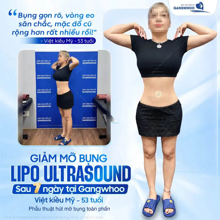 Giảm mỡ bụng Lipo Ultrasound kết quả sau 7 ngày eo thon đẹp gọn hơn thấy rõ