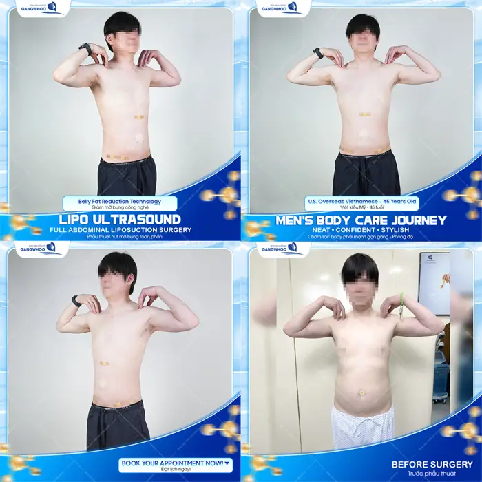 Hút mỡ body toàn phần cho nam body thon gọn, và đầy săn chắc 