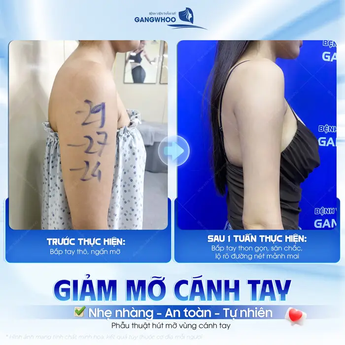 Giảm mỡ cánh tay nhẹ nhàng, an toàn và tự nhiên kết quả sau 1 tuần tái khám đã khác biệt 