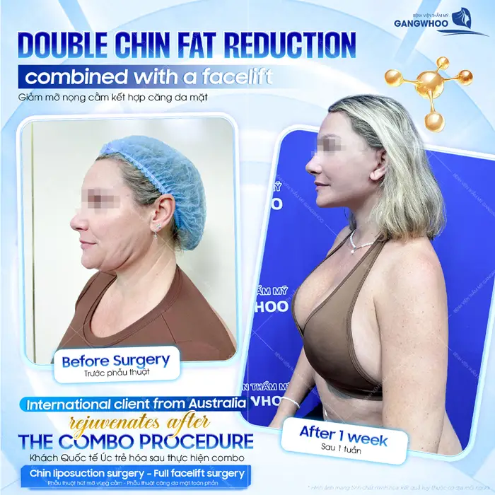 Giảm mỡ nọng cằm kết hợp căng da mặt sau 1 tuần khách quốc tế đến từ Úc đã vô cùng hài lòng về sự thay đổi sau phẫu thuật 