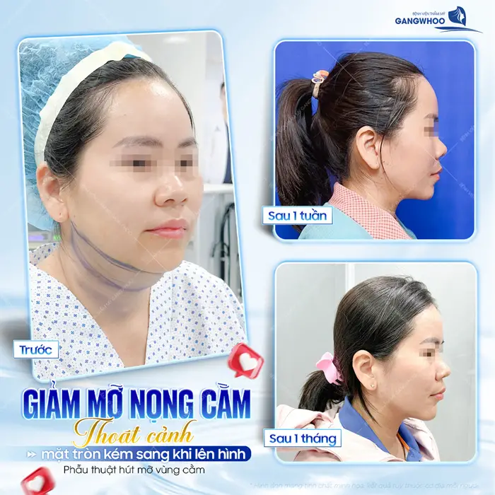 Hút Mỡ Nọng Cằm Giá Bao Nhiêu Tiền? (Cập Nhật Giá 2026) 11 Giảm mỡ nọng cằm thoát cảnh mặt tròn kém sáng khi lên hình sau 1 tháng góc nghiêng đã đẹp chấn động