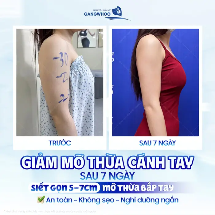 Giảm mỡ thừa cánh tay sau 7 ngày siết gọn mỡ thừa bắp tay an toàn hơn, không để lại sẹo và nghỉ dưỡng ngắn
