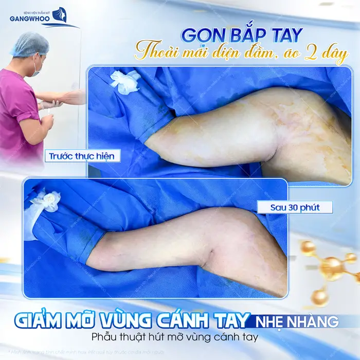 Gọn bắp tay thoải mái diện đầm và áo 2 dây giảm mỡ vùng cánh tay nhẹ nhàng với công nghệ hiện đại