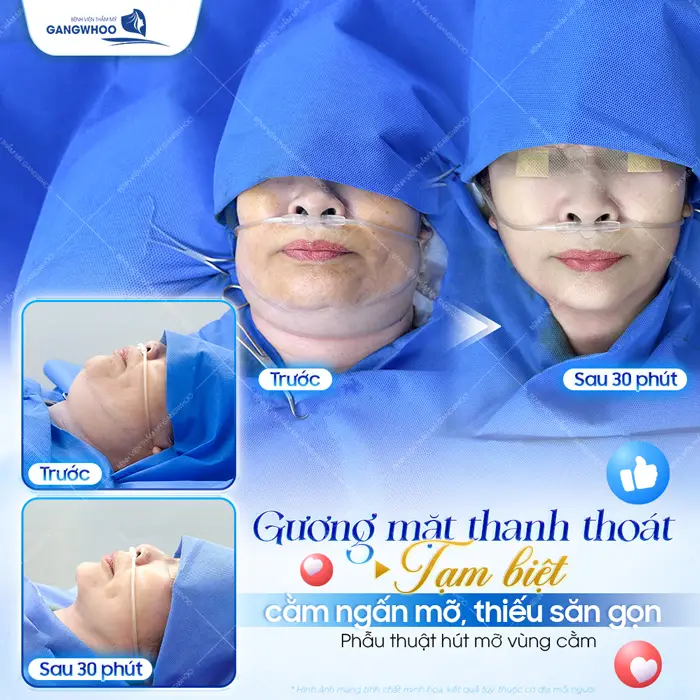 Gương mặt thanh thoát tạm biệt cằm ngấn mỡ, thiếu săn gọn sau 30 phút sự thay đổi đã hoàn toàn khác biệt