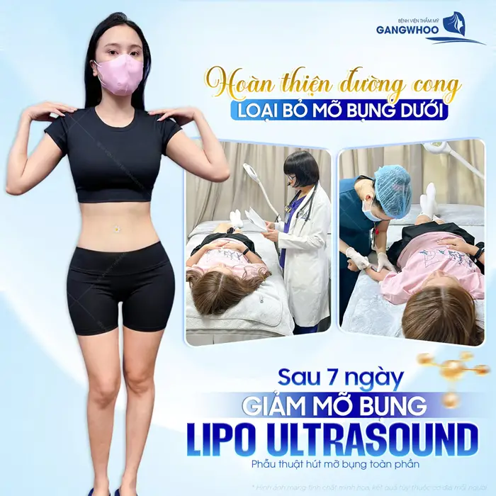 Hoàn thiện đường cong loại bỏ mỡ thừa bụng dưới sau 7 ngày giảm mỡ đã tự tin khoe dáng nuột xuất sắc