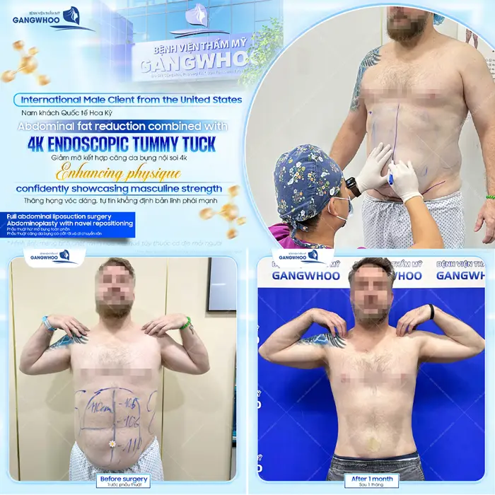 Phẫu thuật chút mỡ kết hợp căng da bụng phái nam tự tin khẳng định bản lĩnh và phong độ sau thực hiện