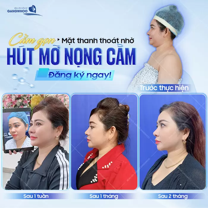 Hút Mỡ Nọng Cằm Giá Bao Nhiêu Tiền? (Cập Nhật Giá 2025) 2 Hút mỡ nọng cằm mặt thanh thoát đẹp chuẩn góc cạnh sau 2 tháng thực hiện