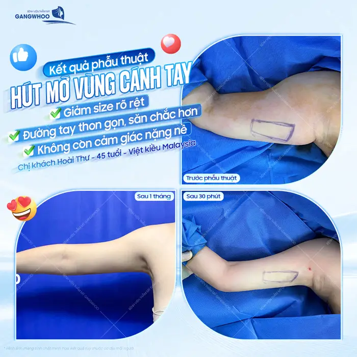 Kết quả phẫu thuật hút mỡ vùng cánh tay giảm size rõ rệt đường tay thon gọn săn chắc 