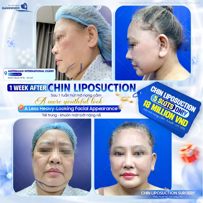 Sau 1 tuần hút mỡ nọng cằm gương mặt trẻ trung và thêm rạng rỡ sau thực hiện 