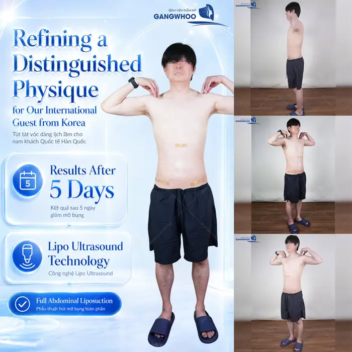 Kết quả sau 5 ngày giảm mỡ bụng Lipo Ultrasound nam giới tự tin khoe eo thon bụng nuột cực ấn tượng