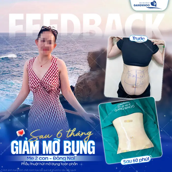 Sau 6 tháng giảm mỡ bụng công nghệ Lipo Ultrasound mẹ 2 con đến từ Đồng Nai đã tự tin diện đầm ôm khoe dáng cực nuột nà