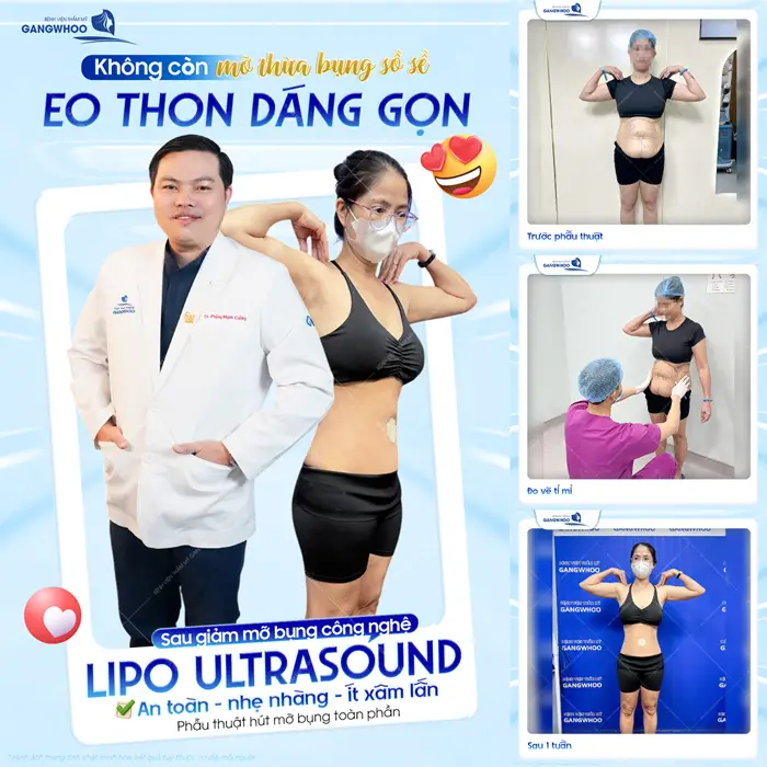 Eo thon dáng gotnj sau giảm mỡ công nghệ Lip o Ultrasound an toàn - nhẹ nhàng và ít xâm lấn