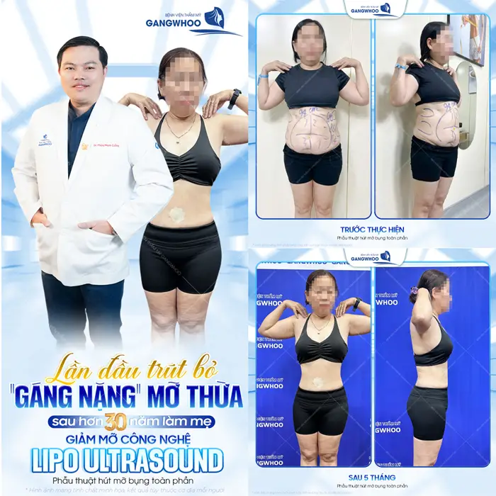 Sau hơn 30 năm làm mẹ giảm mỡ công nghệ Lipo Ultrasound tạm biệt mỡ thừa hiệu quả, an toàn và duy trì kết quả dài lâu