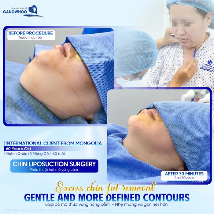 Khách Quốc tế đến từ Mông Cổ sau 30 phút loại bỏ mỡ thừa vùng nọng cằm nhẹ nhàng và sắc gọn hơn