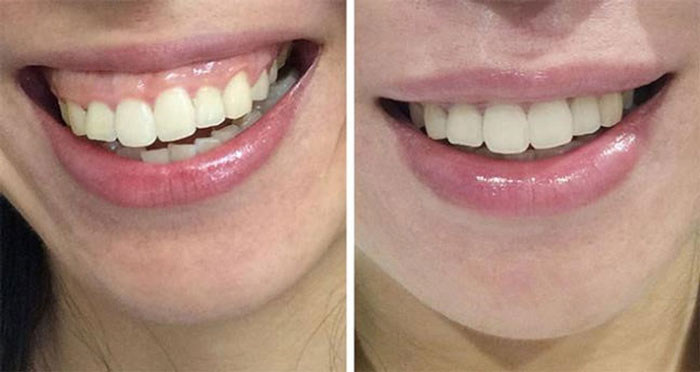 Before & after undergoing gummy smiles treatment surgery