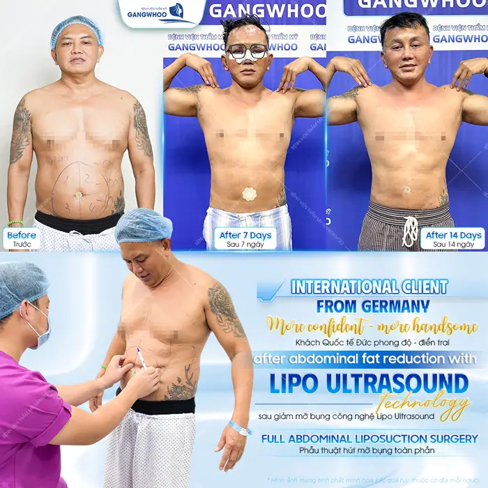 Phẫu thuật hút mỡ bụng nam khách quốc tế đến từ Đức lấy lại phong độ và diện mạo đẹp trai