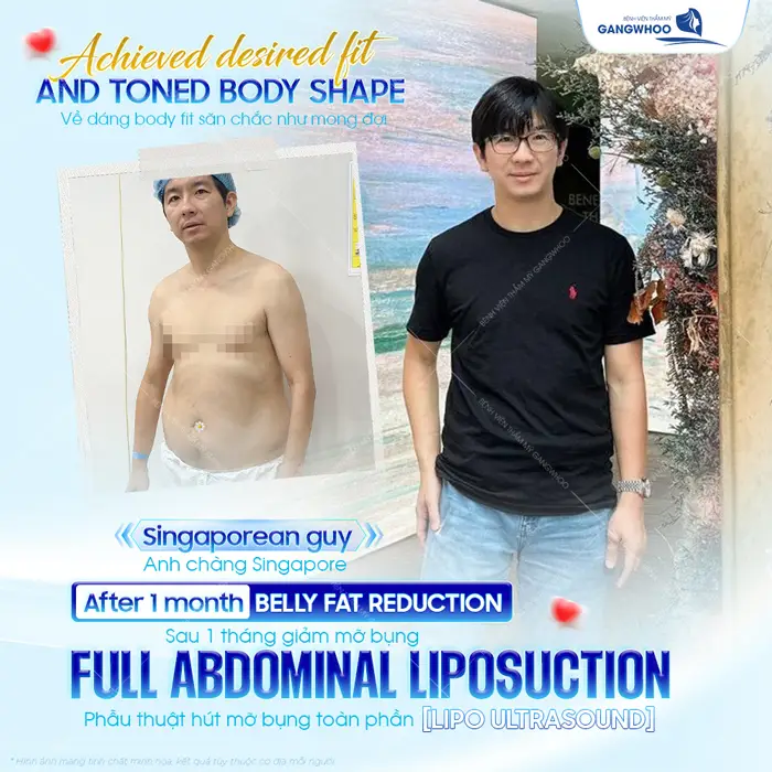 Phẫu thuật hút mỡ bụng toàn phần sau 1 tháng thực hiện chàng trai Singapore đã tự tin với vóc dáng mới