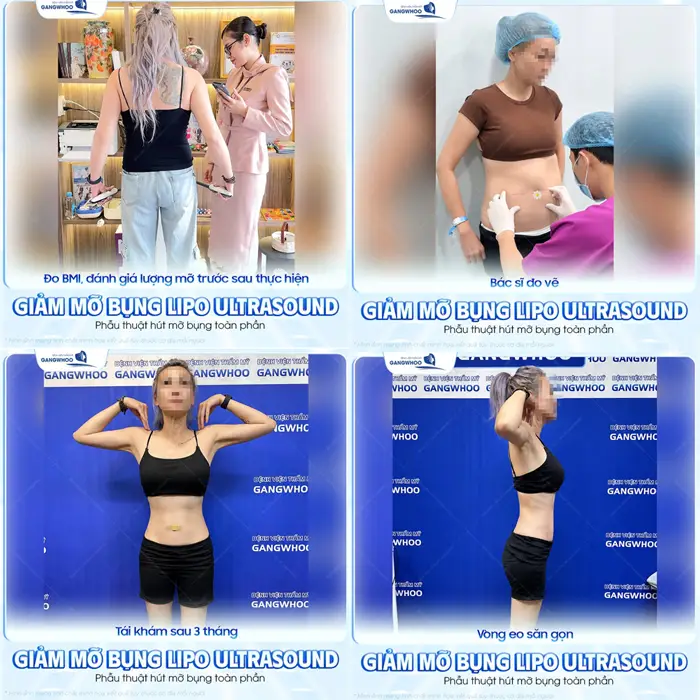 Giảm mỡ bụng công nghệ Lipo Ultrasound đúng quy trình, chuẩn thao tác tự tin khoe eo thon, bụng gọn 