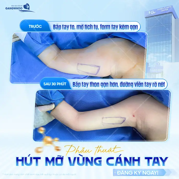 Hút Mỡ Bắp Tay Bao Nhiêu Tiền? Bảng Giá Mới Năm 2026