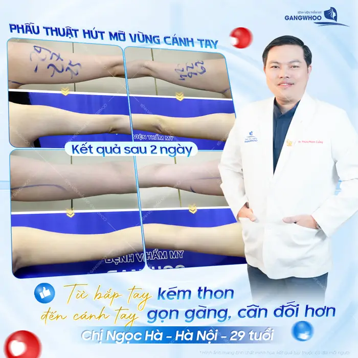 Phẫu thuật hút mỡ vùng cánh tay kết quả sau 2 ngày giải pháp cho đôi tay kém thon gọn hiệu quả 