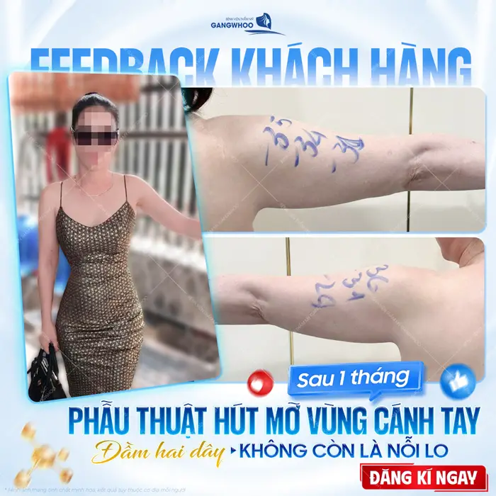 Phẫu thuật hút mỡ vùng cánh tay tay thon gọn đầm 2 tay giờ đây cũng không còn là nỗi lo