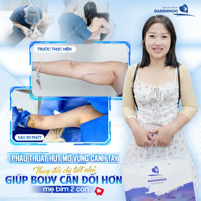 Phẫu thuật hút mỡ vùng cánh tay thay đổi chi tiết nhỏ giúp body cân đối hơn cho mẹ bỉm 2 con