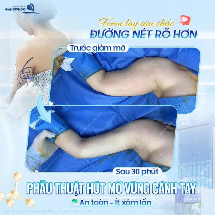 Phẫu thuật hút mỡ vùng cánh tay an toàn, ít xâm lấn form tay săn chắc đường nét đẹp thấy rõ sau 30 ngày thực hiện 