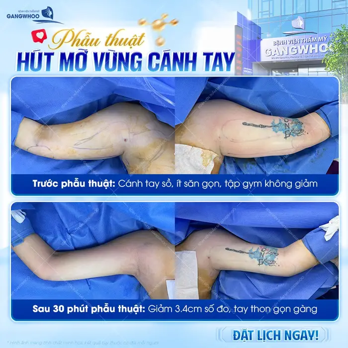 Phẫu thuật hút mỡ vùng cánh tay sau 30 phút phẫu thuật đã tự tin khoe đôi tay đẹp gọn gàng