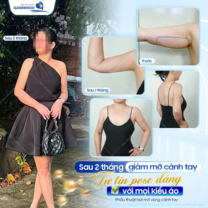 Sau 2 tháng giảm mỡ cánh tay tự tin pose dáng với mọi kiểu áo